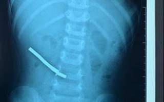 Sốc: Bé trai phải cắt ruột do nuốt 6 thỏi nam châm, 3 kim bấm