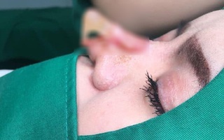 Cận cảnh hình ảnh nâng mũi hỏng của cô gái trẻ khiến nhiều người sợ co rúm!