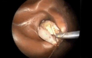 Rùng mình với video gắp châu chấu to bằng ngón tay ra khỏi tai