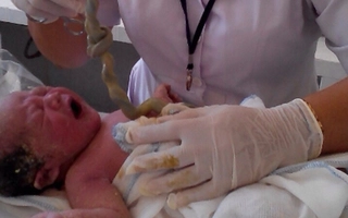 Cứu thành công hai sản phụ chuyển dạ có thai bị dây rốn thắt nút chặt