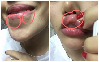Thêm nhiều nạn nhân của Filler dởm trưng bằng chứng, phản pháo chủ spa