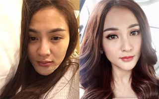 Kelly chấp nhận mất gần 200 triệu để sang Hàn phẫu thuật lại cằm lần thứ 6