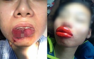 Trào lưu bơm môi căng mọng của chị em và những kết quả... thảm họa không ngờ