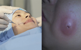 Thẩm mỹ nhấn má lúm - Phương pháp làm đẹp mà bạn phải dè chừng