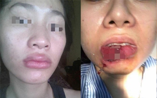 Loạt trường hợp tiêm thẩm mỹ mà đẹp chả thấy đâu, chỉ thấy rùng mình 