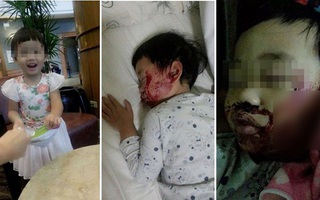 Bố mẹ đừng chủ quan nếu thấy dấu hiệu này ở trẻ sau khi ngã