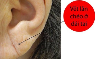 Vết lằn chéo ở dái tai cảnh báo bệnh tim mạch