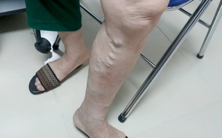 Hàng triệu người Việt mắc bệnh ở chân mà không biết