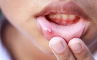 Lở miệng - bệnh không thể coi thường dù là người lớn hay trẻ nhỏ