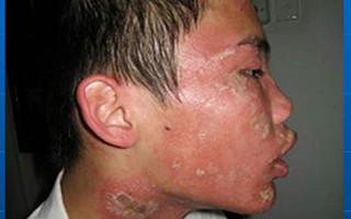 Sốt cao, sưng đau vì nọc độc kiến ba khoang