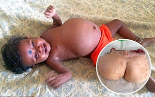 Bé gái mới 15 tháng tuổi mang bào thai nặng 3.5kg trong cơ thể