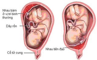 Những nguy hiểm của nhau tiền đạo mẹ bầu nên biết