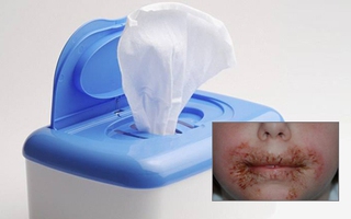 Cảnh báo: Cha mẹ nên hạn chế sử dụng khăn ướt cho con