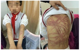 Không làm bài tập, bé trai 9 tuổi bị mẹ nuôi đánh hàng trăm roi vào lưng