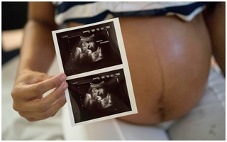 Thai phụ đầu tiên nhiễm virus Zika tại TP.HCM đã chấm dứt thai kỳ