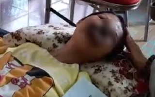 Cô gái ở Đồng Nai mắc bệnh lạ, khuôn mặt bị ăn mòn cả hàm trên và mũi