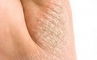 Có thể phòng ngừa bệnh chàm