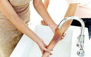Để không bị sẹo do bỏng 