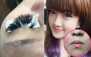 7 tai nạn làm đẹp "lợn lành thành lợn què" mà các nàng phải dè chừng 
