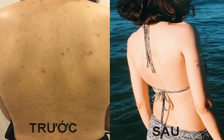 5 phương pháp đơn giản mà hiệu quả giúp đánh bay mụn vùng lưng " khó chiều"
