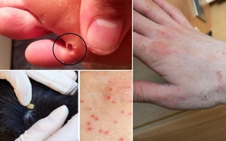 Bạn sẽ không ngờ 10 dấu hiệu này chứng tỏ cơ thể đang nhiễm kí sinh trùng