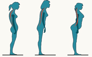 Nhìn tư thế có thể biết bạn có nguy cơ bị đau lưng không
