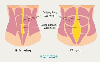 Xổ bụng - điều không mong muốn nhưng rất nhiều chị em gặp phải sau sinh