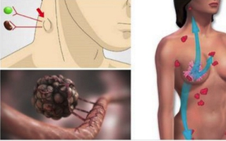 Sưng, nổi hạch trên người có phải là dấu hiệu cảnh báo ung thư?