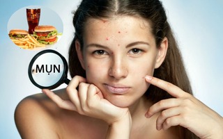 8 thực phẩm càng ăn sẽ càng khiến bạn nổi nhiều mụn trong mùa hè