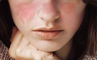 Lupus ban đỏ hệ thống: Bệnh nguy hiểm đến tính mạng nhưng lại khó phát hiện sớm