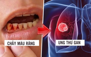 Bệnh nhân ung thư ân hận vì đã lơ là dấu hiệu chảy máu chân răng