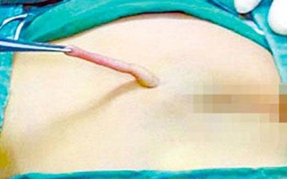Bé gái 4 tháng tuổi mọc đuôi