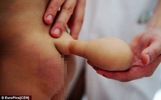 Em bé mọc đuôi 10cm sau mông