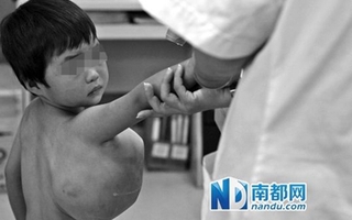 Bé gái có khối u to bằng quả bóng dưới nách