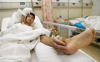 Chàng trai có bàn tay phải "mọc" ở chân