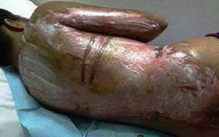 Bà chủ tàn ác ném bình nước sôi vào nữ giúp việc