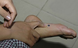 Tưởng vết chai chân, không ngờ mắc ung thư