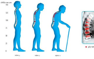 Những giải đáp về sức khỏe của bộ xương