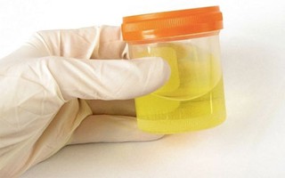 Nước tiểu có bọt: cần đi khám sớm