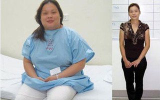 Thắt đai dạ dày giảm béo: hiệu quả gấp 10 lần phương pháp khác