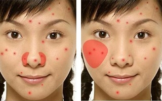 Bắt bệnh cơ thể qua vị trí của mụn trứng cá