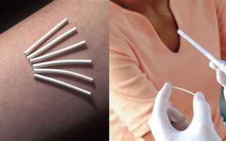 Que cấy tránh thai và một vài rắc rối thường gặp khi sử dụng