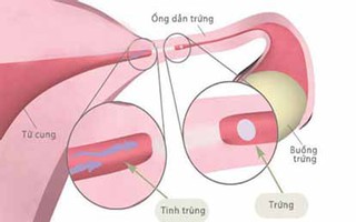 3 dấu hiệu chính nhận biết nguy cơ tắc vòi trứng ở chị em