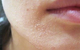 Đồi mồi, nứt nẻ, chàm: Chớ xem thường