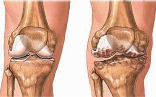 Thuốc làm thay đổi sụn khớp và dịch khớp