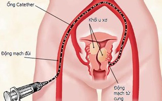 Bí quyết phòng ngừa bệnh u xơ tử cung cho phụ nữ trẻ