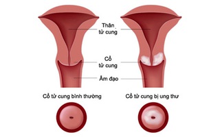 Một vài triệu chứng nhận biết ung thư cổ tử cung