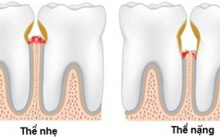 Chớ xem thường bệnh viêm lợi