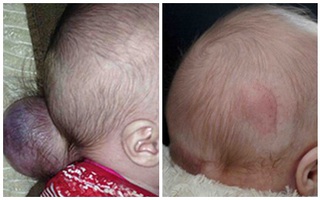Em bé sống sót dù não lồi ra ngoài