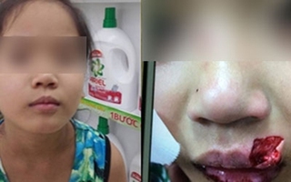 Bé gái 8 tuổi bị chó hàng xóm cắn rách môi